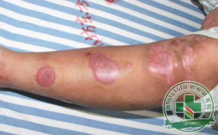 银屑病的治疗要注意些什么?