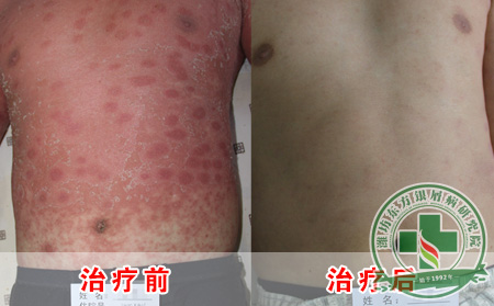 喝酒会影响银屑病病情吗?