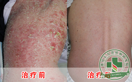 银屑病危害有哪些?