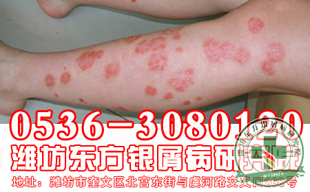 简述:治疗银屑病一定要选对时期