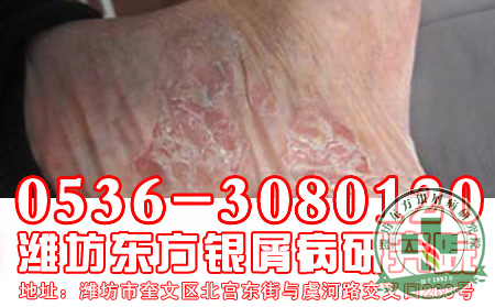 如何解析及治疗牛皮癣？