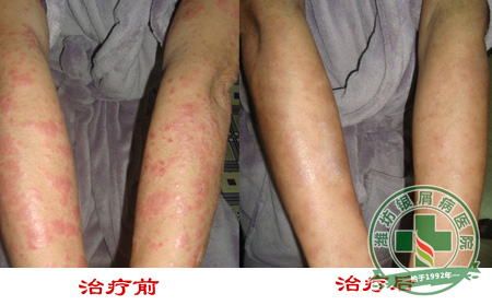 银屑病容易被忽视的症状?