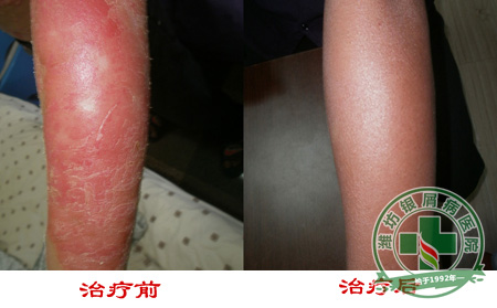 银屑病治疗避免过度着急
