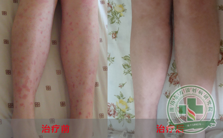 关节型银屑病生活中该怎样保健呢