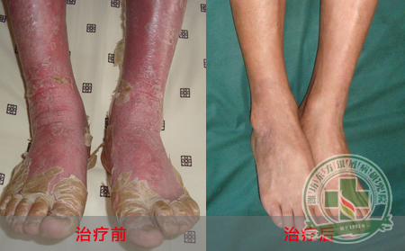 寻常型银屑病有哪些症状表现呢?