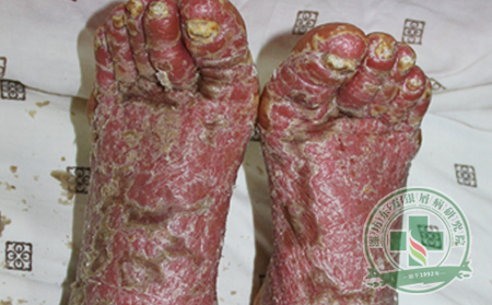 依据症状治疗关节型银屑病