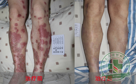脓疱型银屑病的病理依据是怎样的?