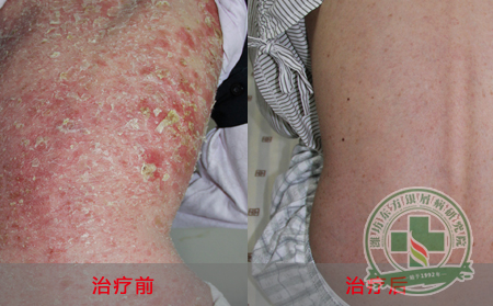 银屑病遗传能提前预防吗？