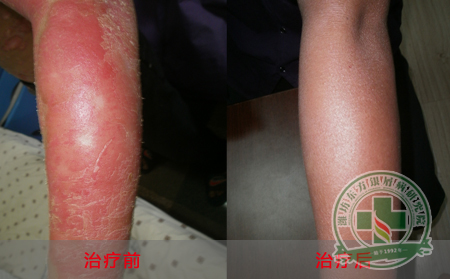 如何让银屑病患者吃出健康？