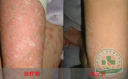 银屑病再复发可以解决吗?