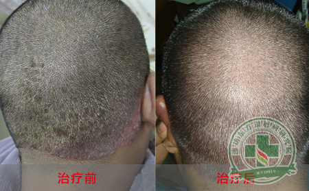 面部银屑病要科学洗脸