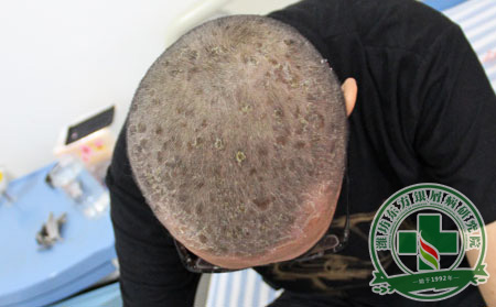 潍坊东方银屑病研究院对头部银屑病患者的发型建议