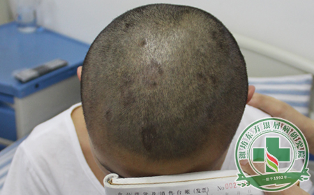 头部银屑病治疗