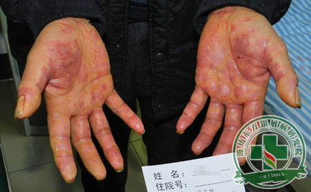 关节型牛皮癣产生的各种情况性变化