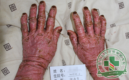 要治可以关节型牛皮癣不容易，看看具体怎么办