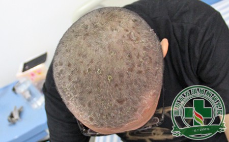 潍坊牛皮癣如何治治疗效果果比较可以呢?