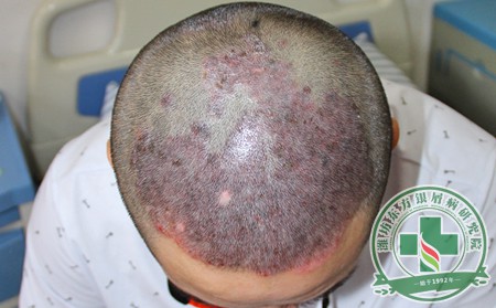 青少年银屑病患者病情发的危害有哪些?