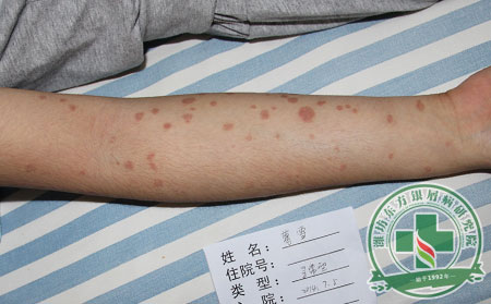 什么样的情绪容易影响银屑病症状治疗