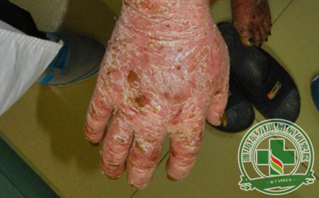 潍坊哪里能医治银屑病