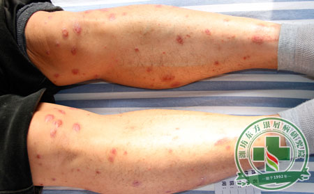 为什么银屑病患者更偏向使用药物治疗银屑病