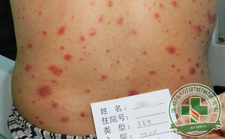 牛皮癣治疗