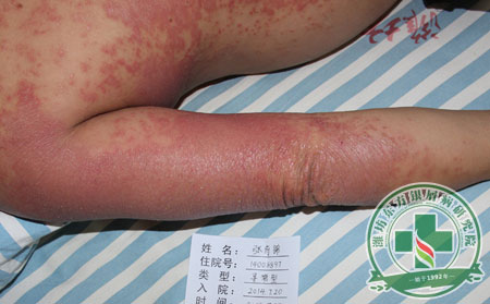 潍坊银屑病治疗医院可以在哪里