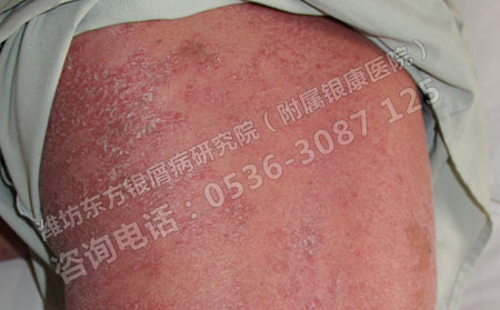 红皮型牛皮癣那么顽固怎么治疗
