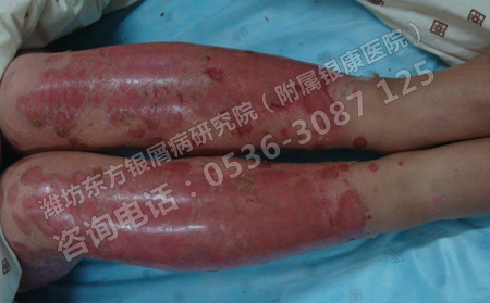 导致老年牛皮癣患者二次复发的原因是什么