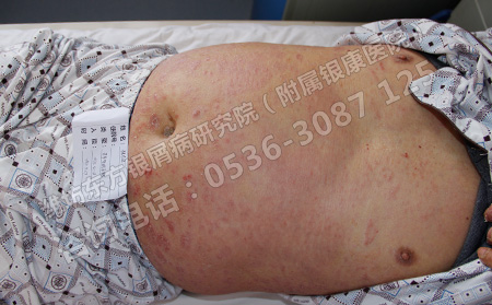 潍坊寻常型银屑病怎么护理呢