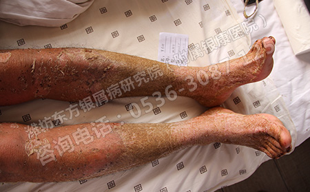 潍坊治疗银屑病的老中医在哪家医院