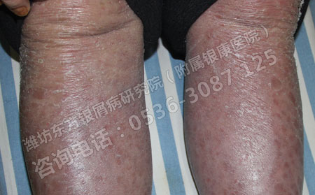 银屑病可以自愈吗