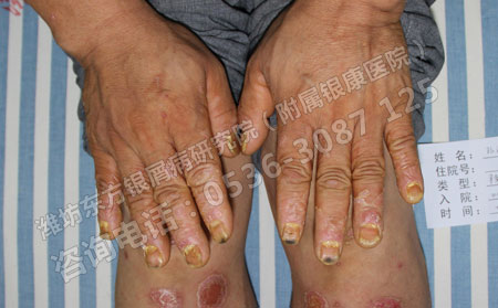 潍坊市银屑病科医院在哪里