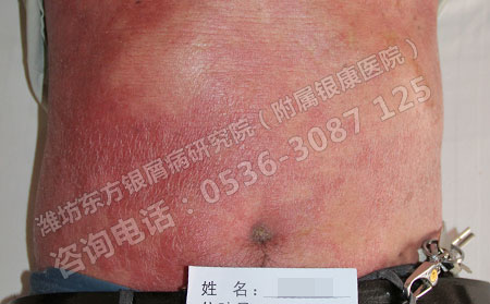 潍坊有哪些正规的银屑病医院