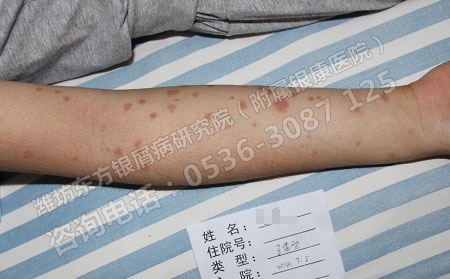 潍坊哪个医院治疗银屑病非常可以?怎么去