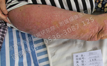 潍坊防治牛皮癣的方法有哪些呢
