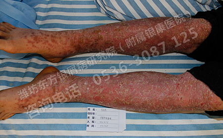 潍坊哪里的医院治银屑病不错