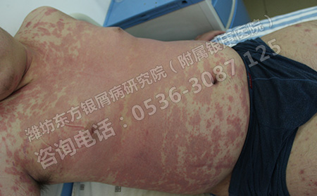 潍坊治疗银屑病的有效药有哪些