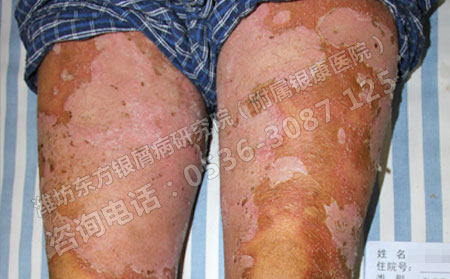 达力士能治可以银屑病吗