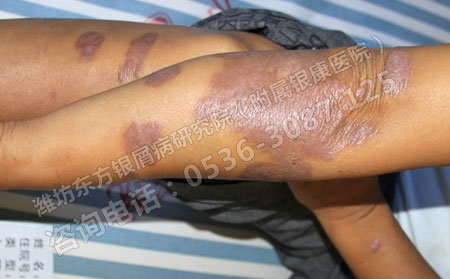 治银屑病潍坊哪有地儿