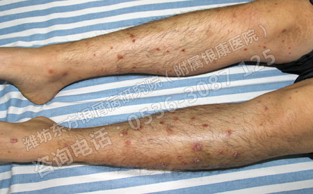 潍坊银屑病要怎么治治疗效果果才可以