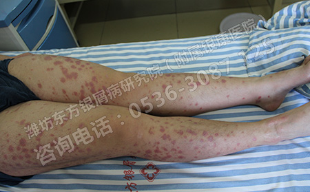 避免寻常型牛皮癣恶化要怎么做