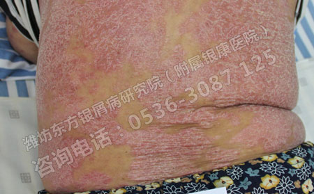 了解牛皮癣常识才能更可以的治疗