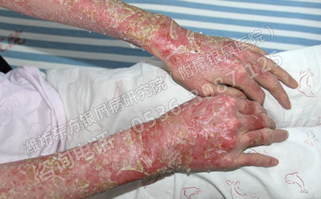 治可以牛皮癣必须要做到三点