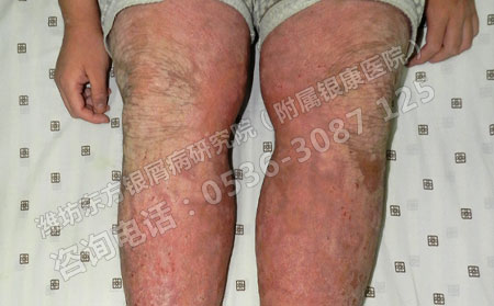 潍坊哪家医院治疗银屑病非常可以