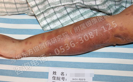 哪家医院看银屑病效果不错