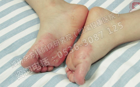 牛皮癣真的遗传么，那我以后还能结婚生子吗