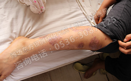 了解牛皮癣常识性知识控制病情恶化
