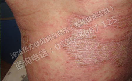 盘点牛皮癣患者不得不知的常识知识