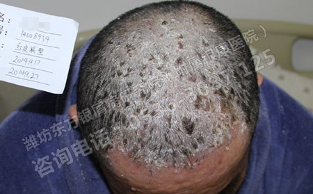 银屑病患者染发,银屑病可以染发吗