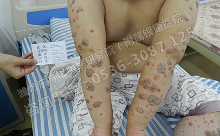 潍坊银屑病医院患者的恢复过程
